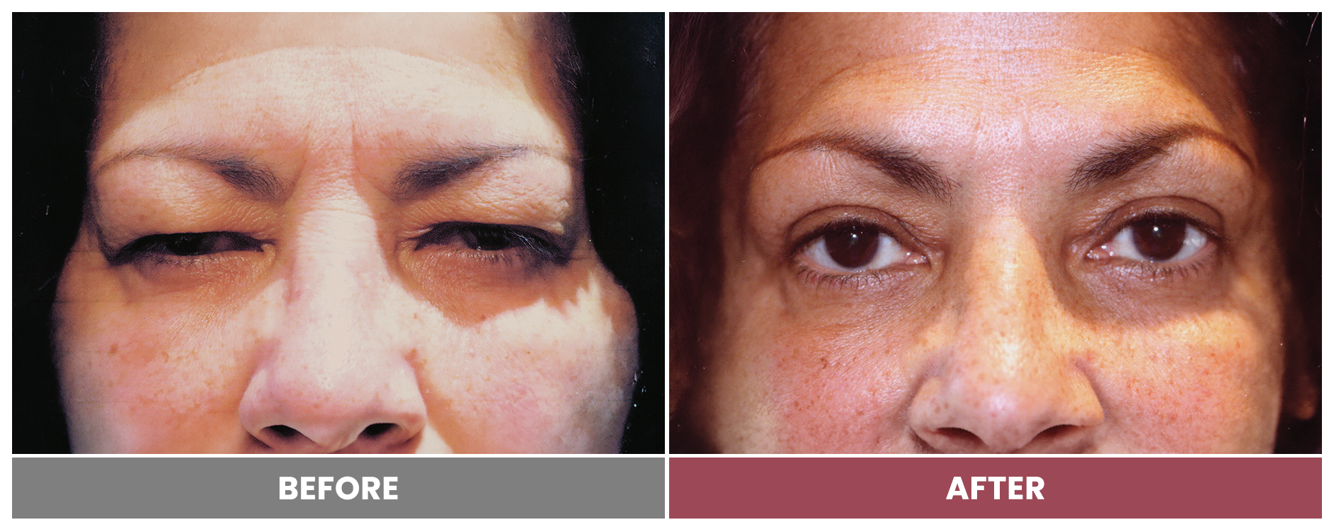Upper Blepharoplasty - Case 27